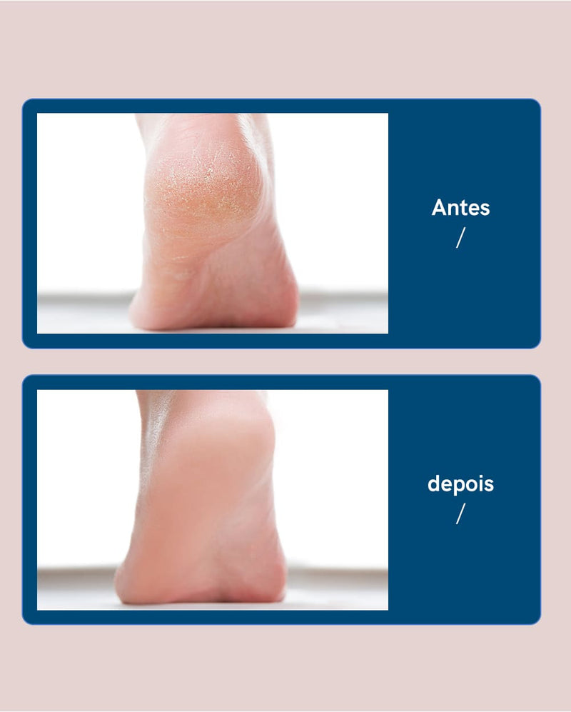 Lixa Elétrica Removedora de Calos e Rachaduras - Soft Skin + Pente de lixa grossa de brinde