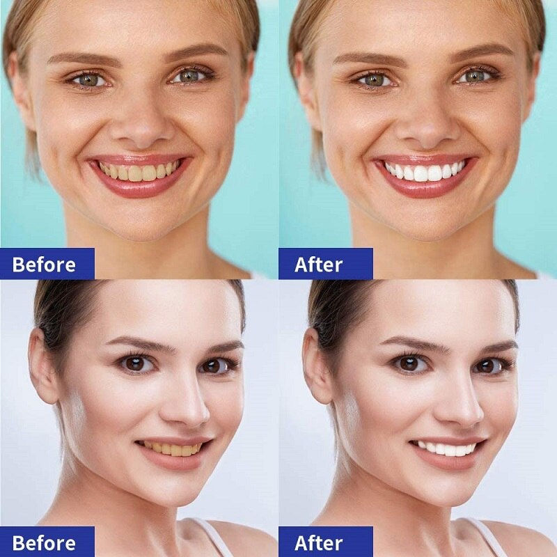 AdesivWhite 5D+ - Adesivo para Clareamento Dental